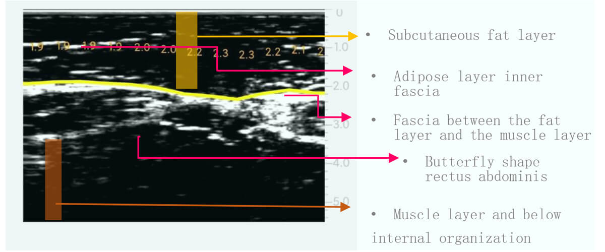 Subcutaneous-tissue-sonogram