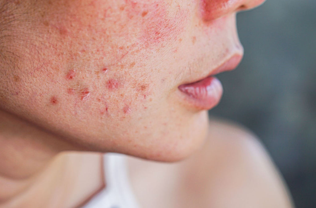 Skin 101: reasons you shouldn't pop your pimple (and what s – Caci