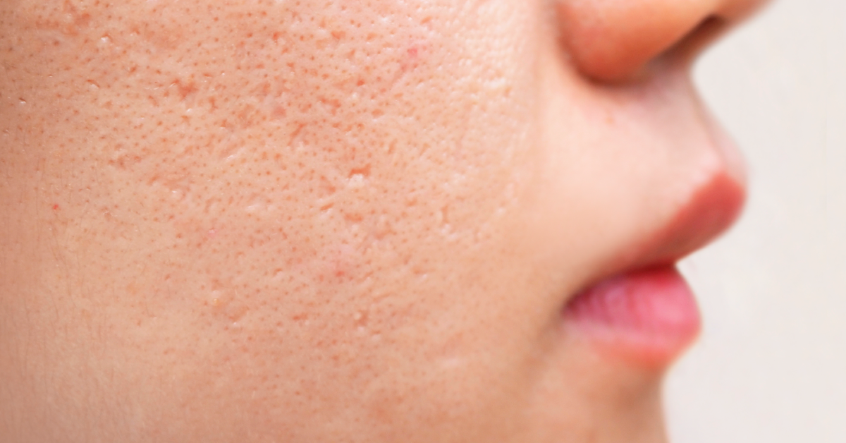 Why am i getting acne on my body? Decoding Body Acne 101