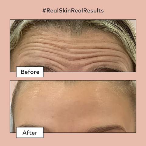 Forehead Lines Before and After