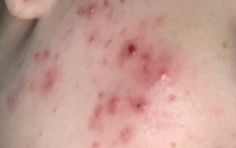 acne-scarring