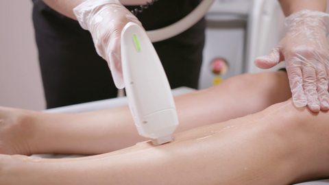 Laser hair removal