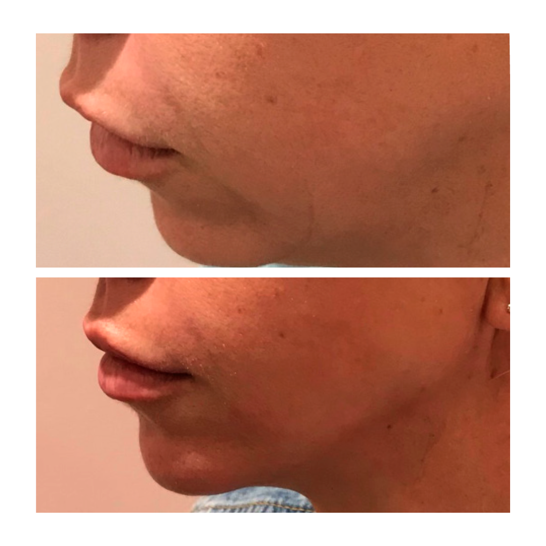 Dermal Filler - Chin and jawline 