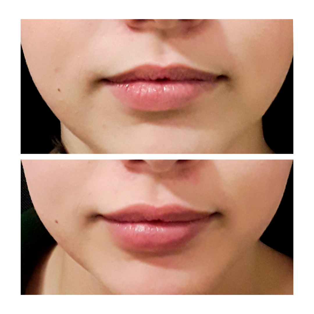 Dermal Filler - Lips 