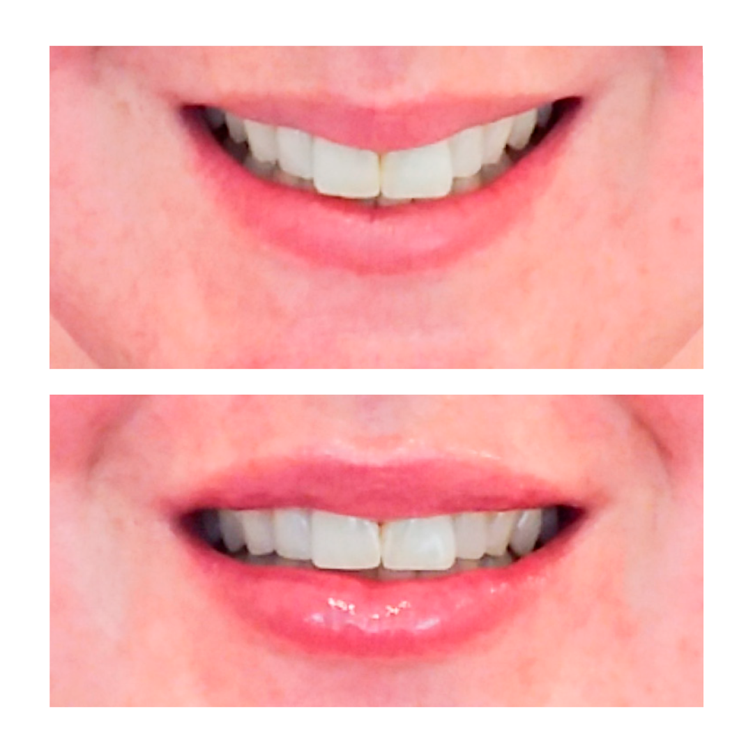 Dermal Filler - Lips 1ml 