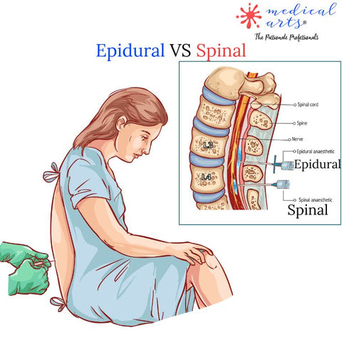 epidural vs spinal