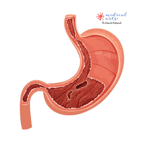 Stomach Ulcer ◑ Peptic Ulcer ● H.Pylori ◒ Medical Animations 3d ◐ Medical Arts