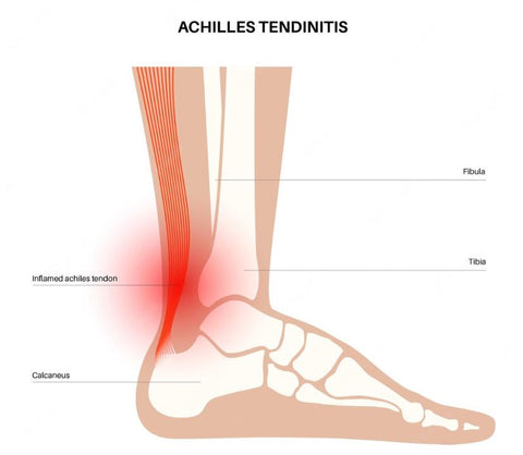 cause of ankle pain Achille tendinitis 