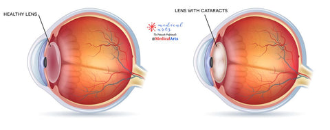 cataract - lens implant - eye surgery - medical arts 