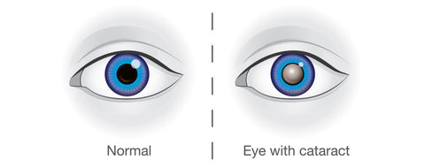 cataract - lens implant - eye surgery - medical arts