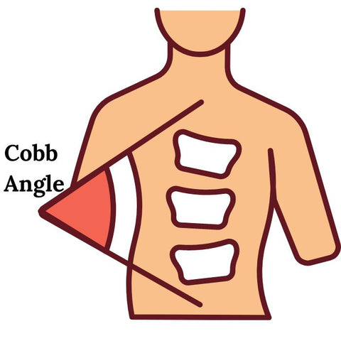cobb angle Scoliosis types, causes, symptoms and treatment.