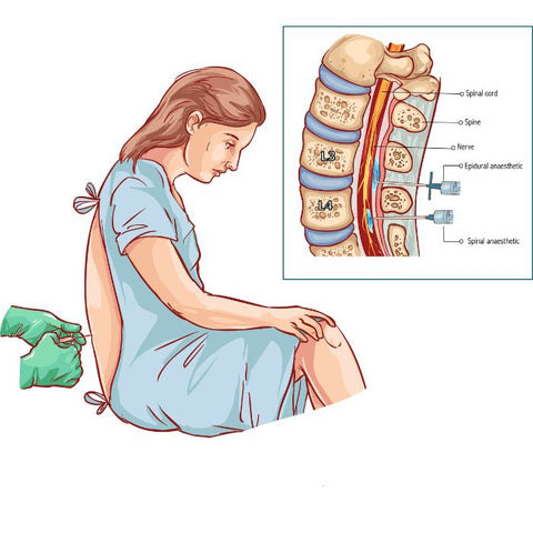 epidural vs spinal anesthesia medical arts shop