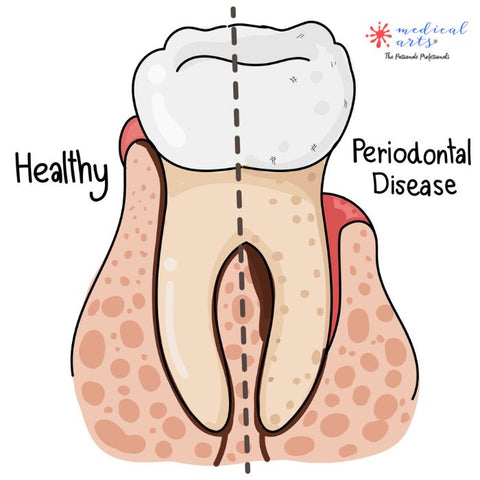 gum graft surgery