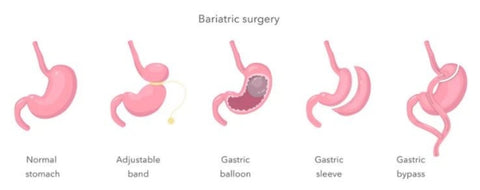 sleeve gastrectomy - bariatric surgery - weight loss surgery - medicalarts
