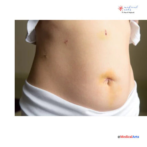 sleeve gastrectomy - bariatric surgery - weight loss surgery