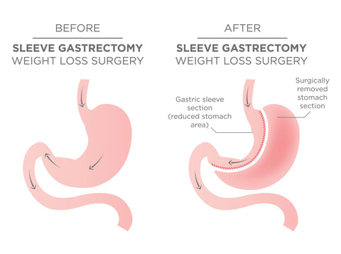 sleeve gastrectomy - bariatric surgery - weight loss surgery