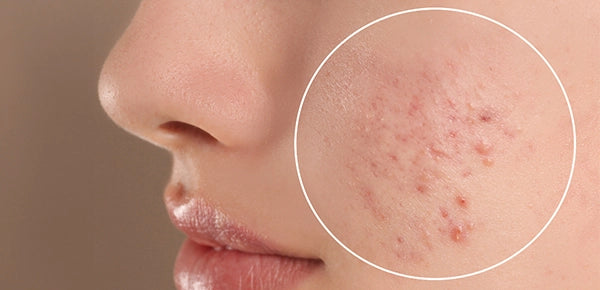 Image of teenage girl with acne problem with closeup