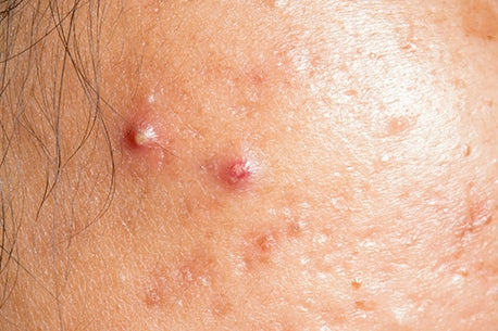 Image of close-up of acne on the face, showing skin blemishes