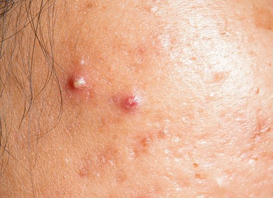Image of close-up of acne on the face, showing skin blemishes
