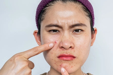Picture of woman pointing to inflamed acne on her face