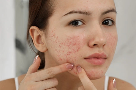 Image of girl with acne problem squeezing pimple indoors