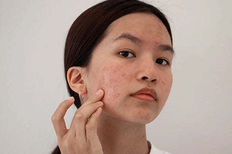 Picture of woman with acne, illustrating common skin condition