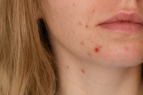image of woman showing her facial acne