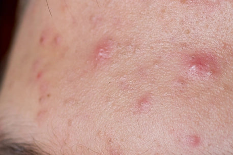 Image of acne on the forehead, a common skin issue
