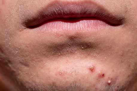 Image of acne on the chin of a person's face