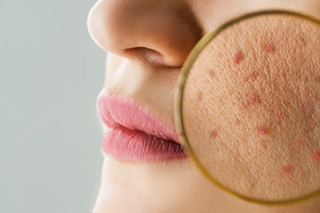 Examining skin acne problems up close picture