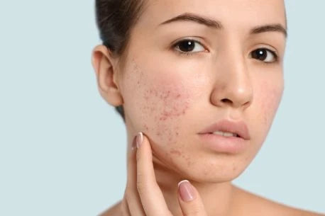 A picture of a girl with an acne problem on her face