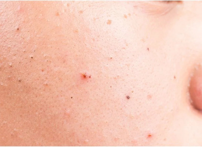 Blackheads Images Photo Gallery Of Skin Pictures The Pink Foundry