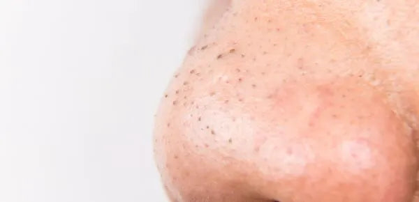 Close up of blackheads on face images showing clogged pores on nose and cheek skin