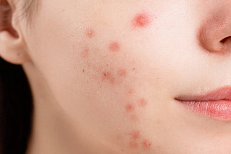 picture of close-up shot of a woman's face with acne problem