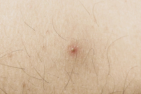 Nodular acne picture on the leg skin