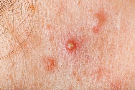 Image of nodular cystic acne on the skin