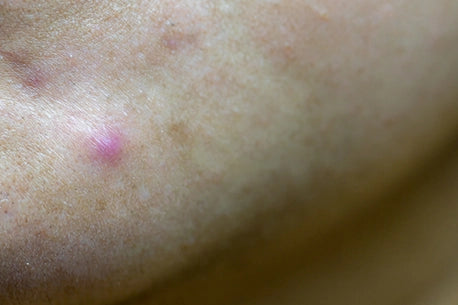 Close-up image of nodular cystic acne on a woman's skin, displaying chronic acne
