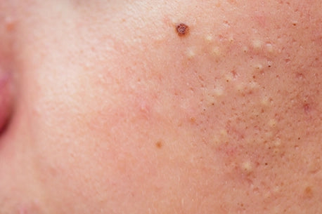 Close-up of pimples on a woman's face image
