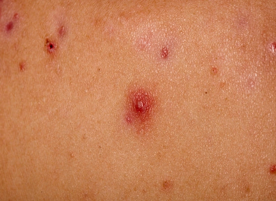 Isolated close-up images of painful cystic acne
