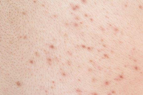 Acne image on the back of woman skin