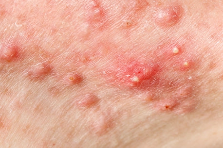 Nodular cystic acne picture skin with close-up view