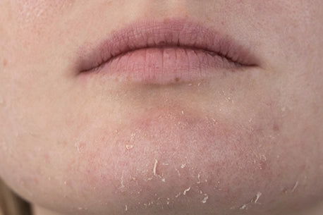 Photo of woman examining dry skin on her face