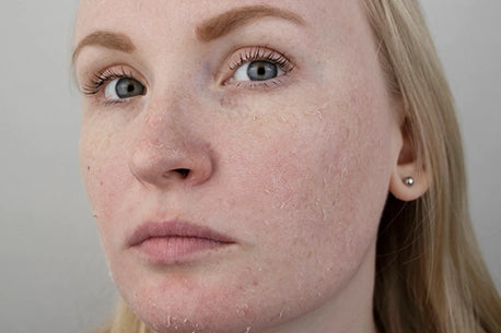 Image of woman with dry skin on her face
