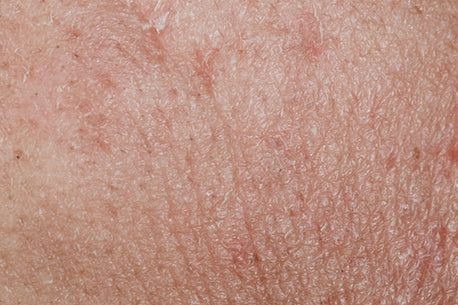 Image of dry skin texture, showing signs of dehydration and discomfort