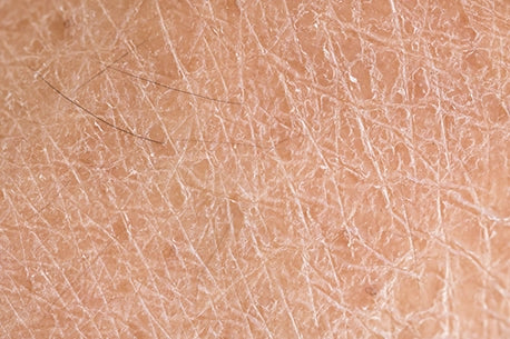 Image of detailed view of dry skin (ichthyosis), illustrating its texture and condition