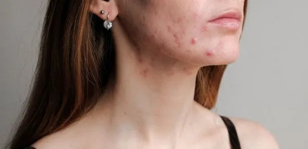 Pictures of Hormonal Acne portraying skin challenges related to hormonal imbalances