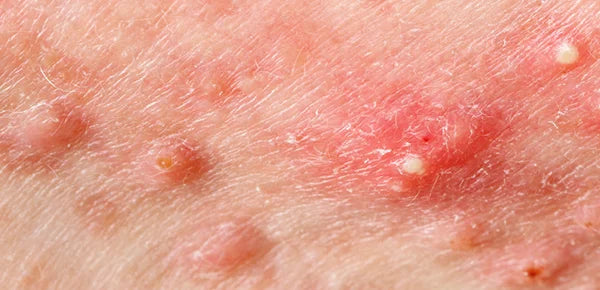 Picture of nodular cystic acne skin, displaying severe and inflamed acne lesions