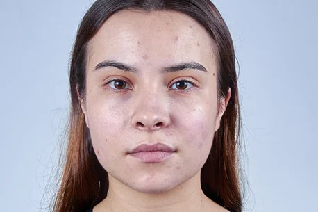 Photo of young woman practicing prevention for oily skin and acne
