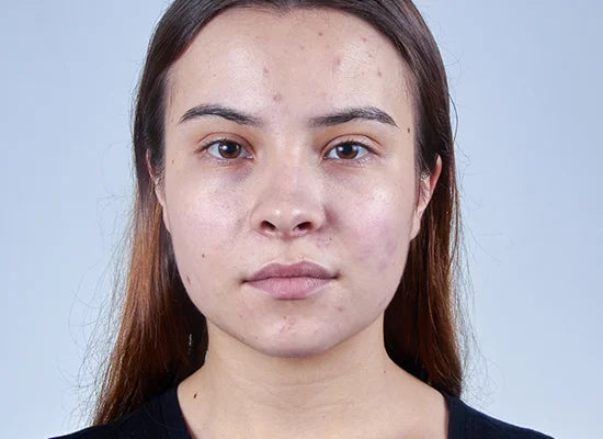 Photo of young woman practicing prevention for oily skin and acne