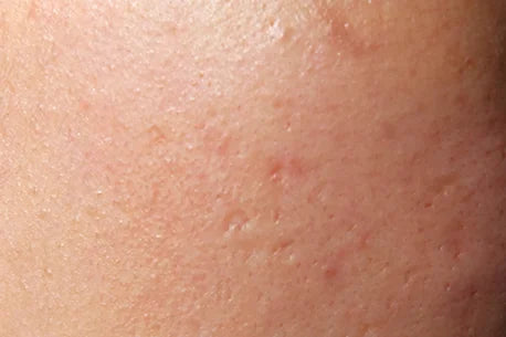 Photo of woman with oily skin and acne scars